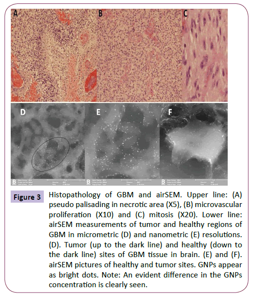 nanotechnology-pseudo-palisading-necrotic